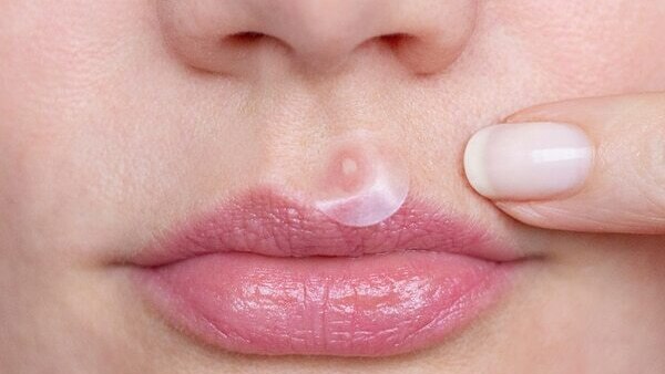Spot treatment