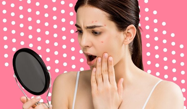 What Is Hormonal Acne And What Is The Best Way To Deal With It?
