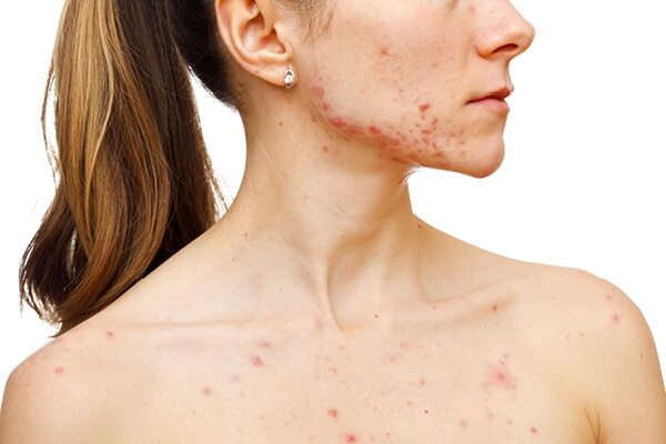 FAQs about hormonal acne
