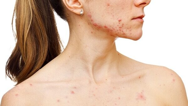 FAQs about hormonal acne