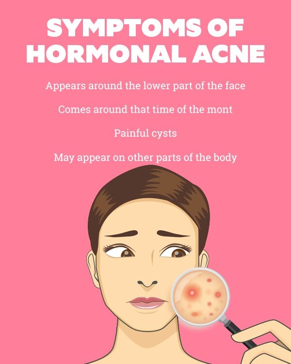 FAQs about hormonal acne