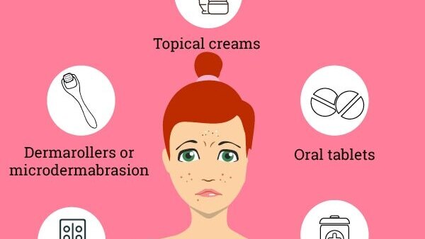 FAQs about hormonal acne