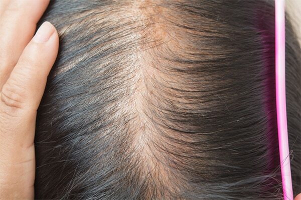 FAQs about female pattern baldness