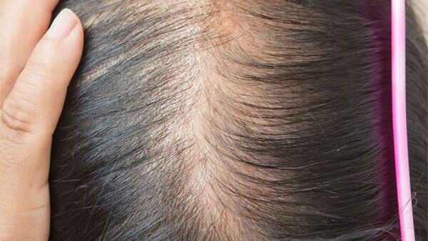 FAQs about female pattern baldness