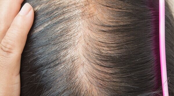 FAQs about female pattern baldness