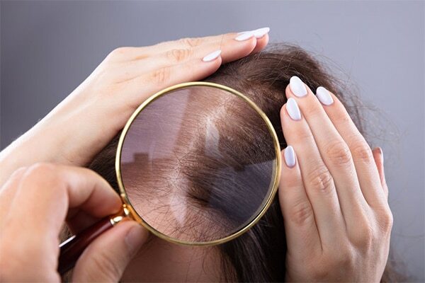 FAQs about female pattern baldness