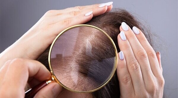 FAQs about female pattern baldness