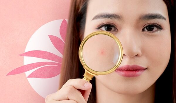 Treating Blind Pimples Like Regular Zits Here’s Why It Won’t Work
