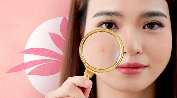 Treating Blind Pimples Like Regular Zits Here’s Why It Won’t Work