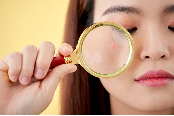 04. How to deal with blind pimples?