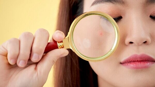 04. How to deal with blind pimples?