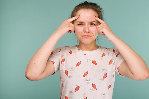 FAQs about pimples on forehead