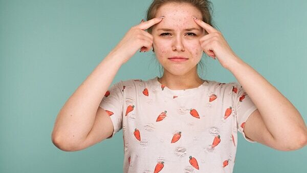 FAQs about pimples on forehead