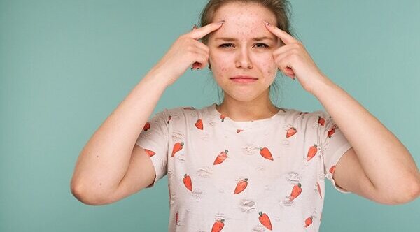 FAQs about pimples on forehead