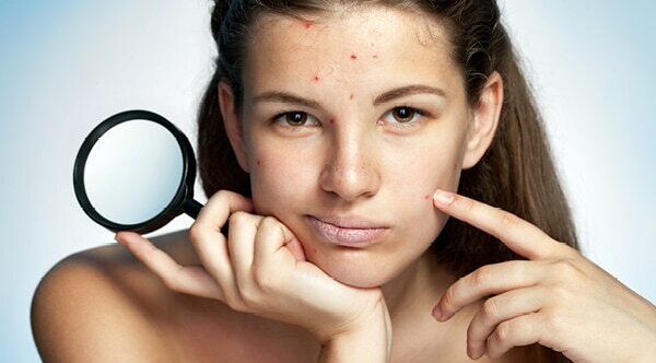 FAQs about pimples on forehead