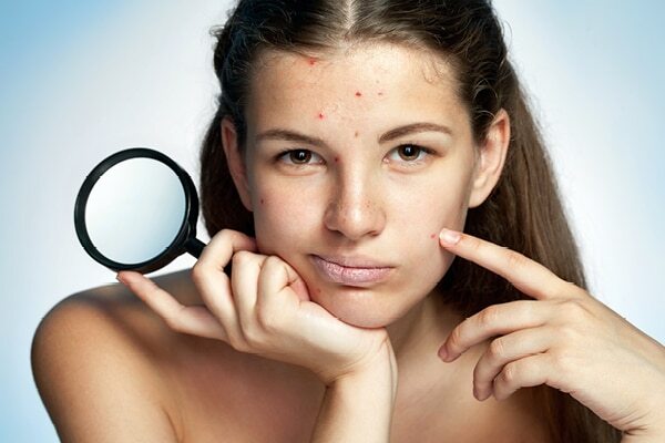 FAQs about pimples on forehead