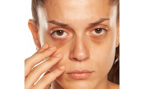 FAQs about dark circle treatment