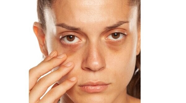 FAQs about dark circle treatment