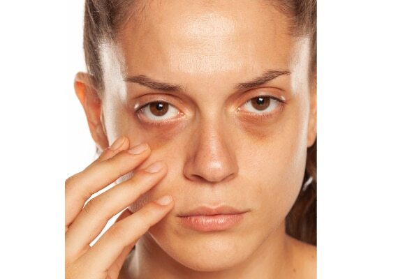 FAQs about dark circle treatment