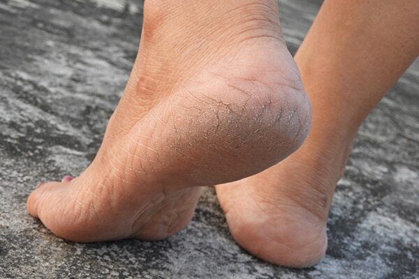 Dr. Niketa’s everyday tips to prevent dry feet and heal cracked heels
