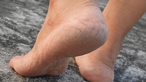 Dr. Niketa’s everyday tips to prevent dry feet and heal cracked heels