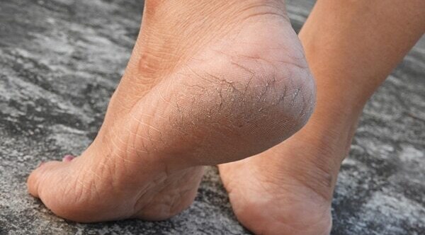 Dr. Niketa’s everyday tips to prevent dry feet and heal cracked heels
