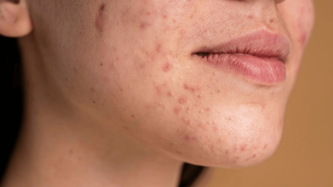 How to Remove Pimple Marks Naturally: Top Remedies and Tips for Brighter Skin