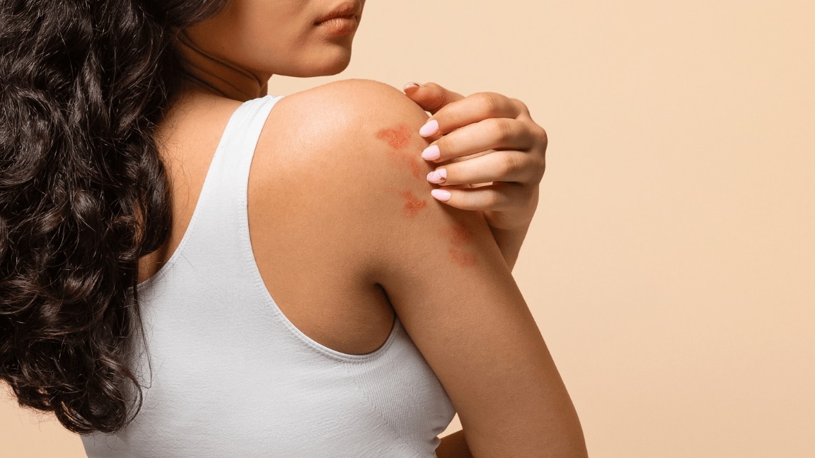 Suffering From Endometriosis And Skin Flare Ups? The Two Are More Connected Than You’d Think