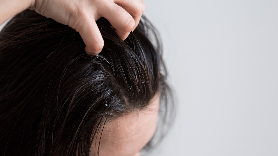Home Remedies to Cure Dry Scalp: Simple Solutions That Work