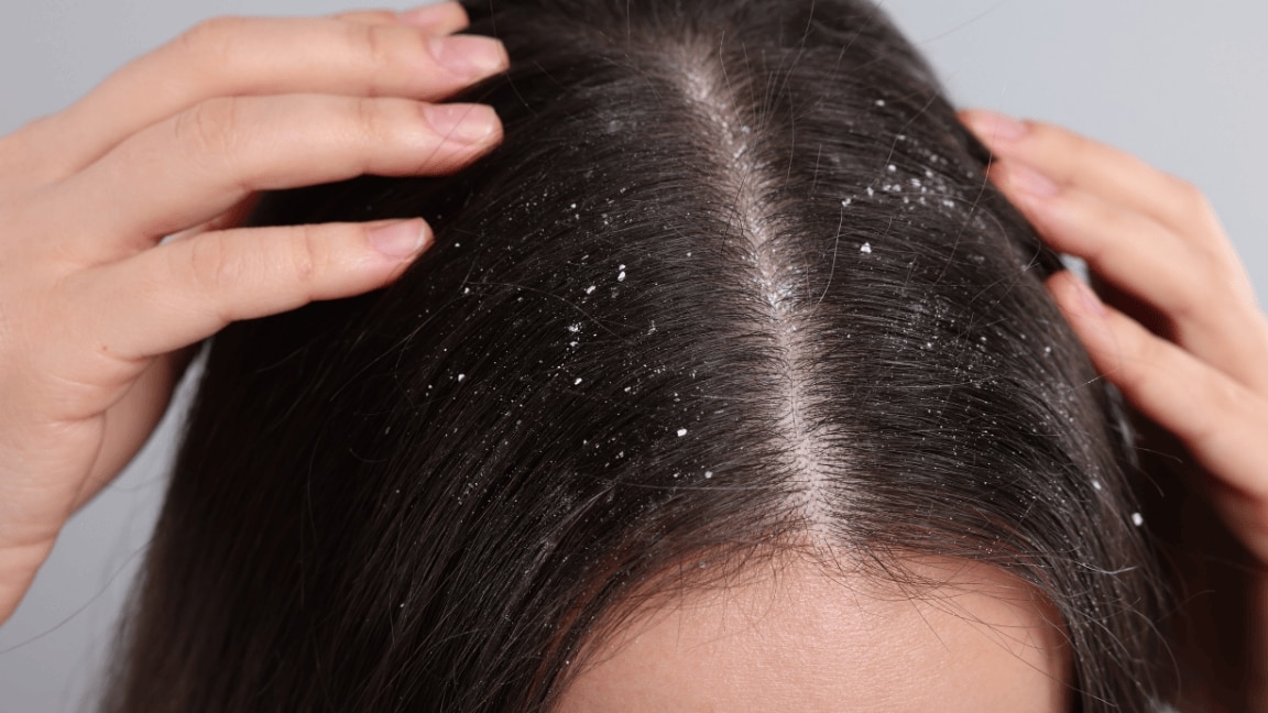 Say Goodbye To A Flaky Scalp: Best Home Remedies For Dandruff Treatment
