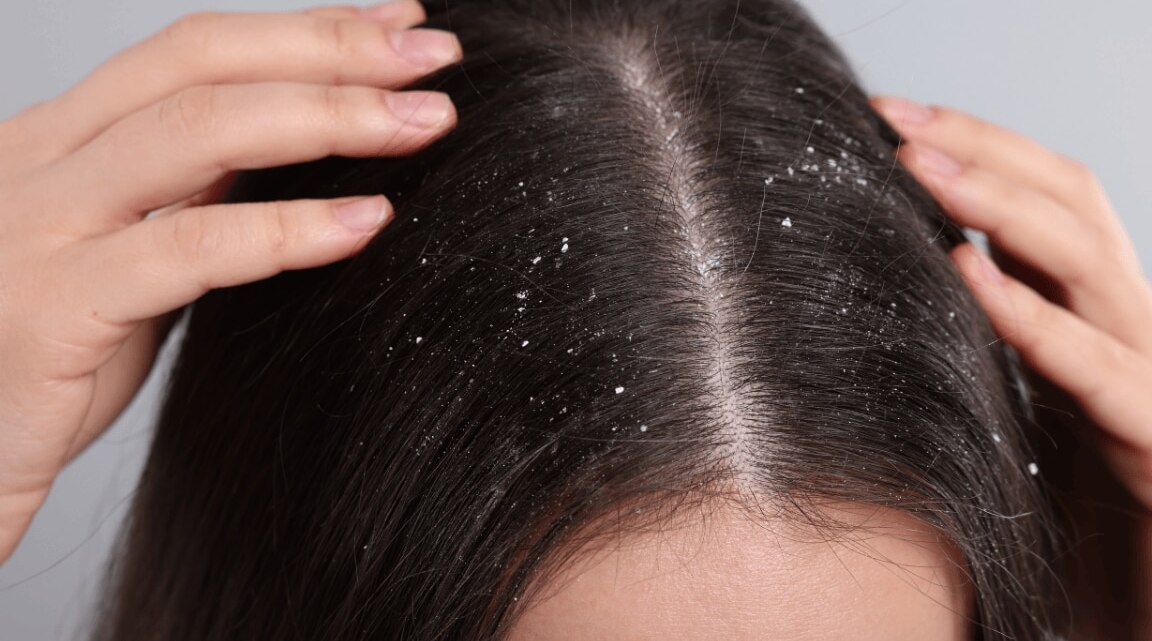 Say Goodbye To A Flaky Scalp: Best Home Remedies For Dandruff Treatment
