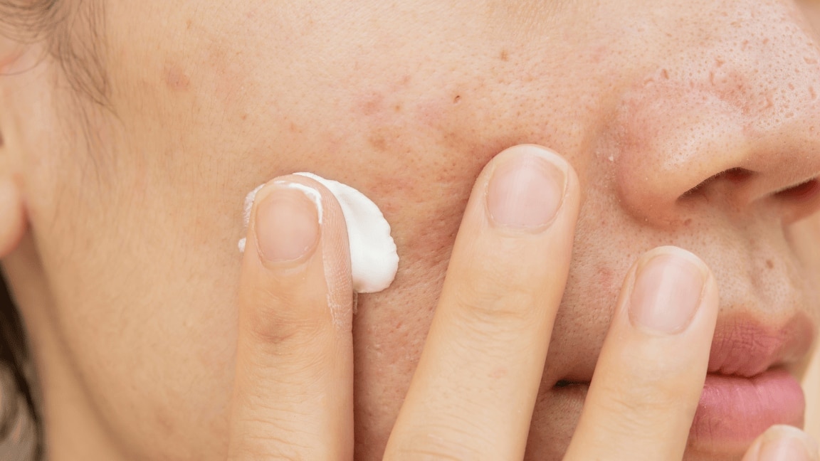 Sun's Out, Dark Spots Begone: Your Go-to Sunscreen for Dark Spots