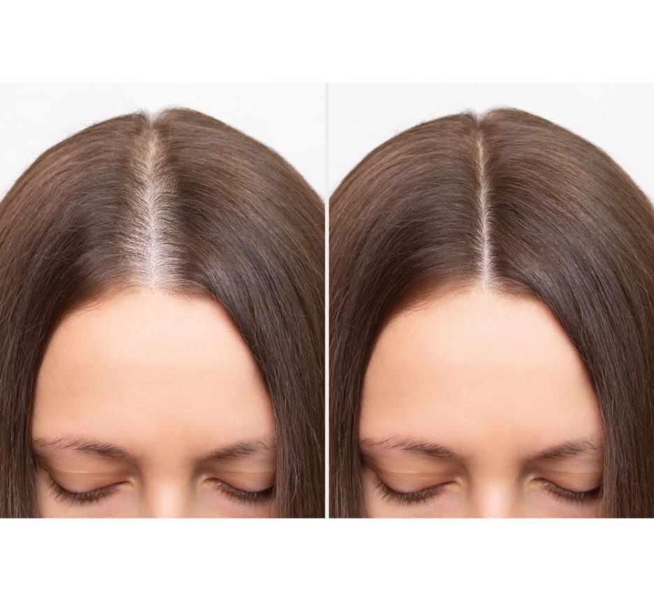 cấy tóc cấy tóc là gì hình ảnh so sánh trước và sau khi cấy thêm tóc