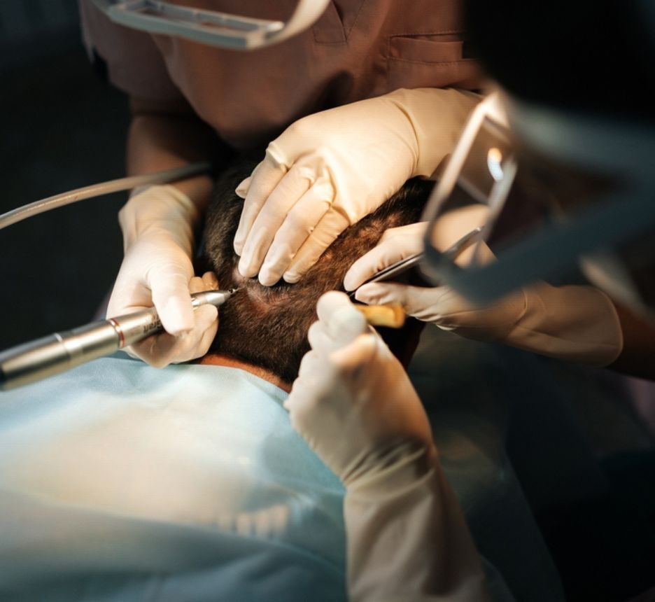 cấy tóc cấy tóc tự thân là gì và có thực sự hiệu quả không cận cảnh bác sĩ đang thu thập nang tóc tự nhiên của bệnh nhân