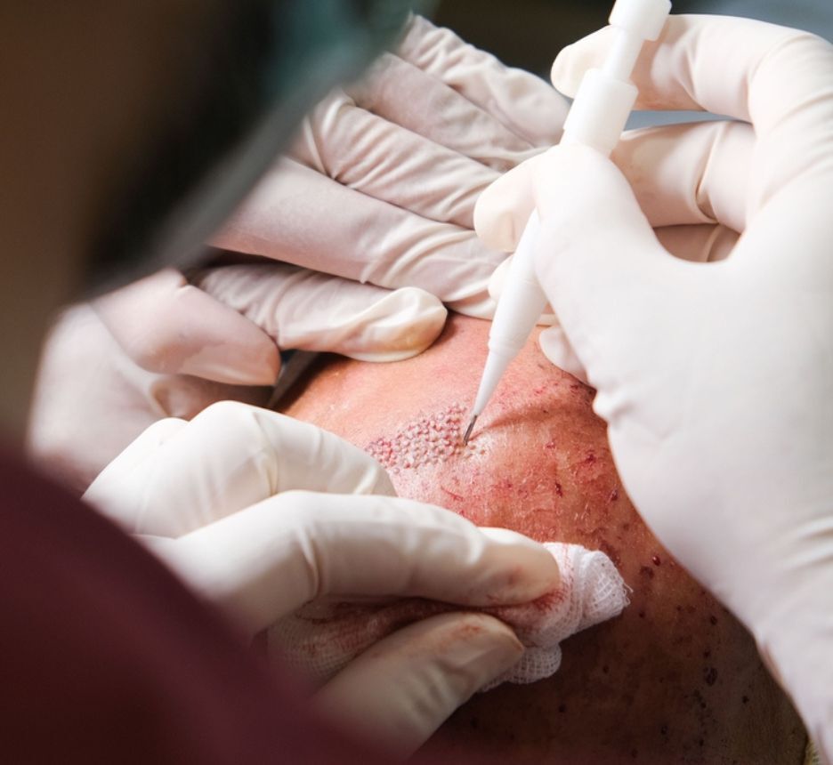 cấy tóc cấy tóc sinh học là gì và có thực sự hiệu quả không ảnh cận cảnh bác sĩ đang đưa nang tóc nhân tạo vào da đầu