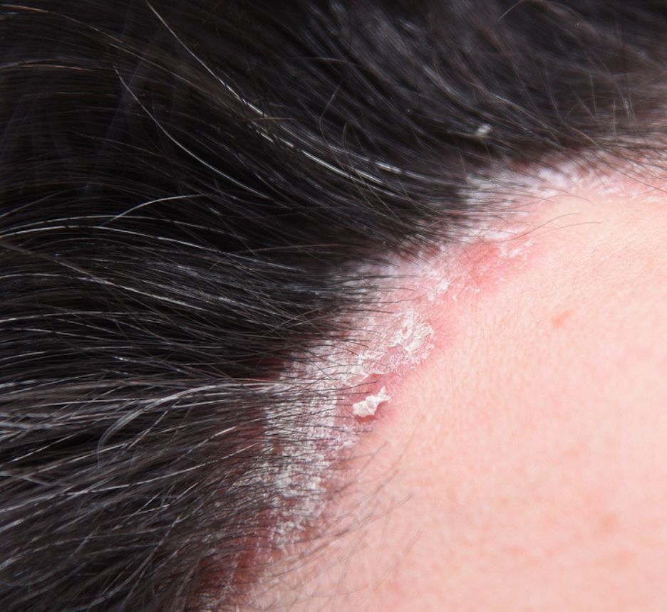 vảy nến da đầu vảy nến da đầu là gì ảnh chụp cận đường chân tóc bị vảy nến