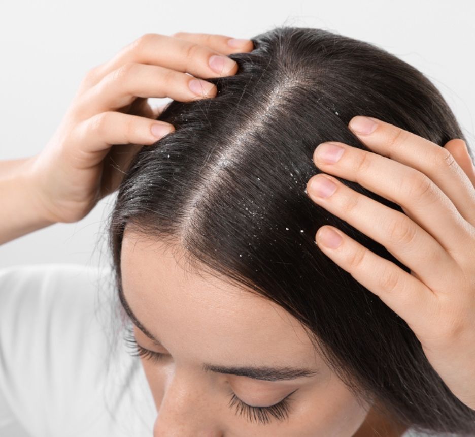 ngứa da đầu về đêm ngứa da đầu về đêm do gàu cô gái đang đặt tay lên đầu