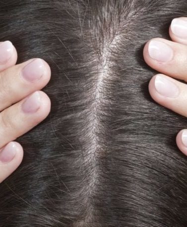 Itchy scalp: Close up of a woman's scalp and brown hair