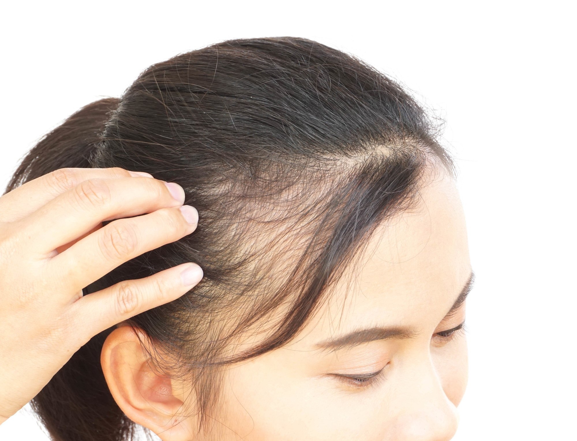 shedding: woman with thin hair