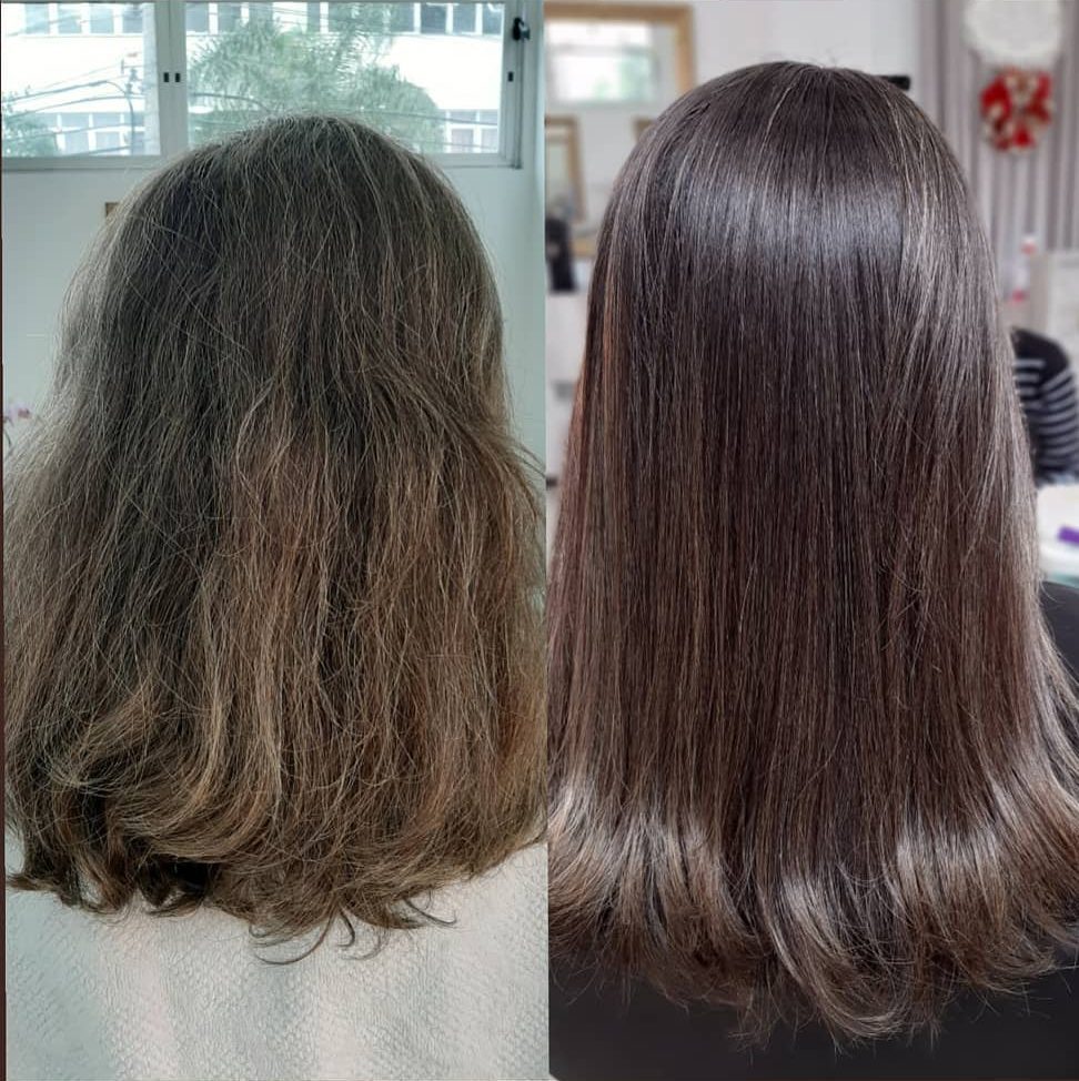 mulher antes e depois da exoplastia capilar