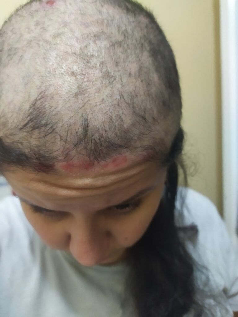 mulher com cabelo caindo