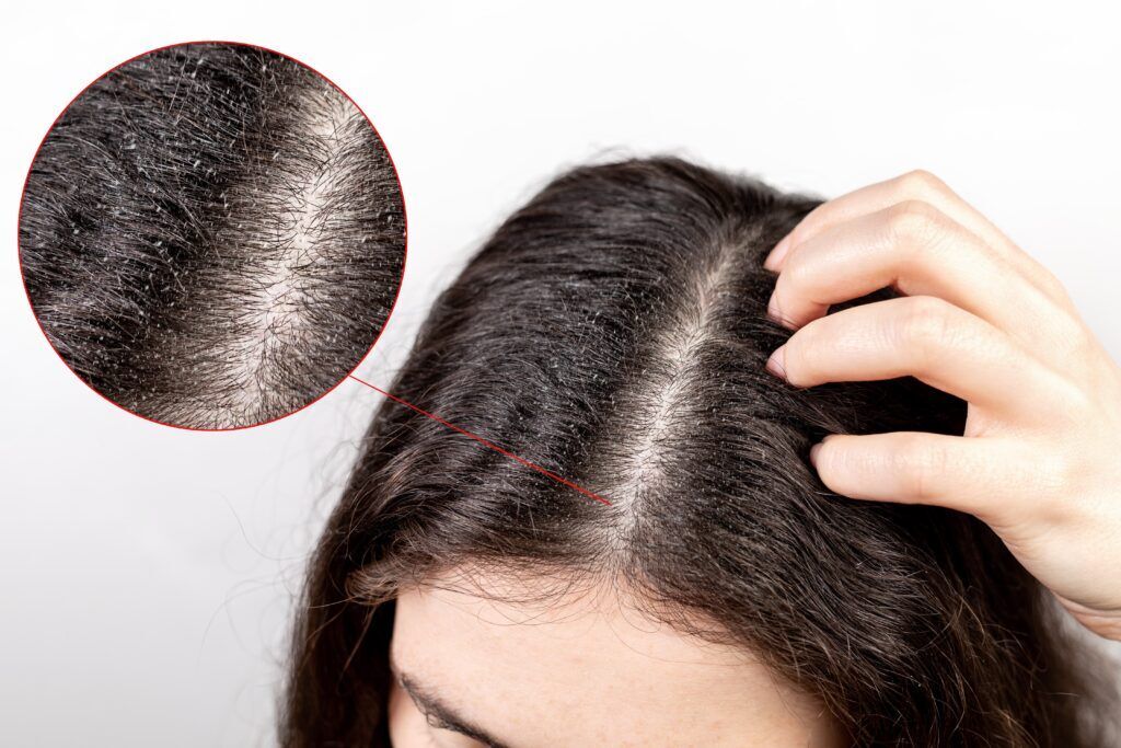 Mulher com doença no couro cabeludo dermatite seborreica ou caspa