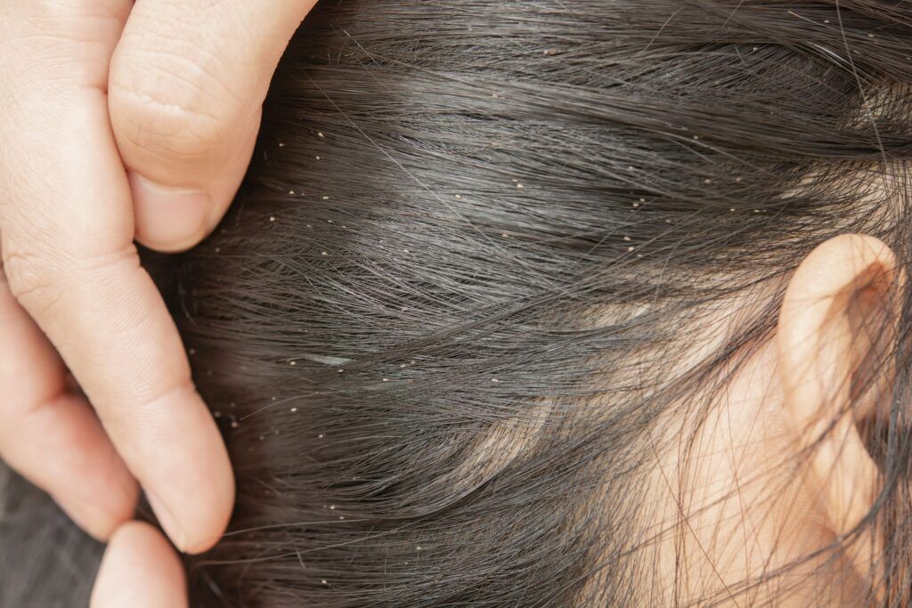 cabelo com piolhos