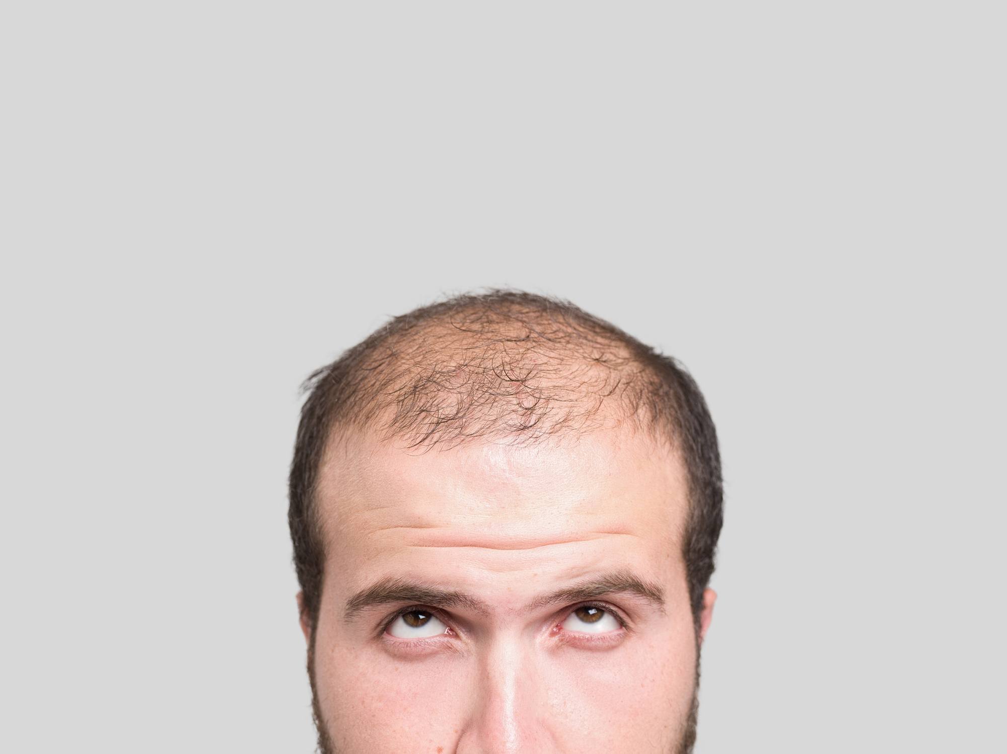Homem com calvície no cabelo