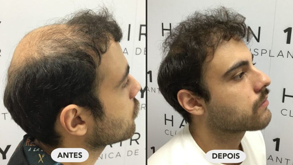 antes e depois do implante capilar