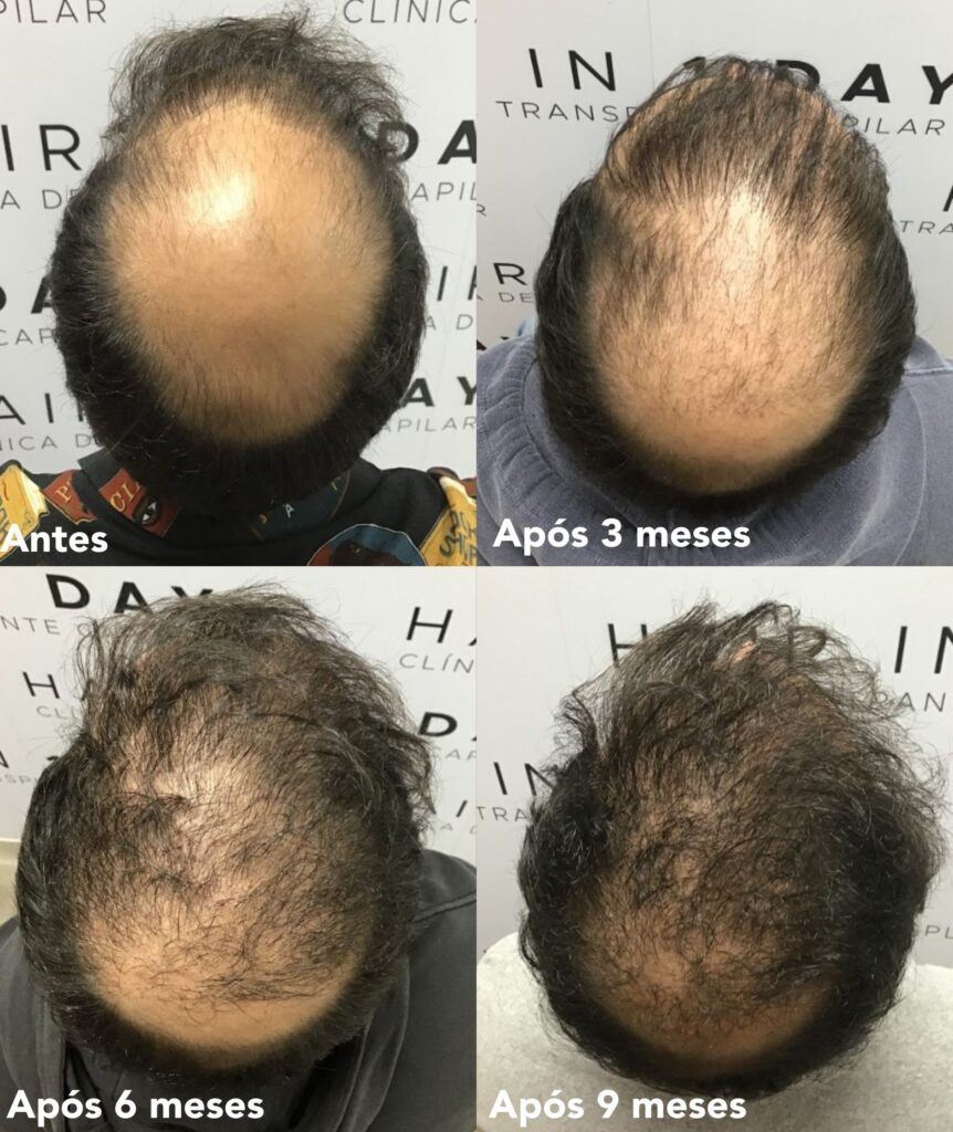 implante capilar resultado antes e depois