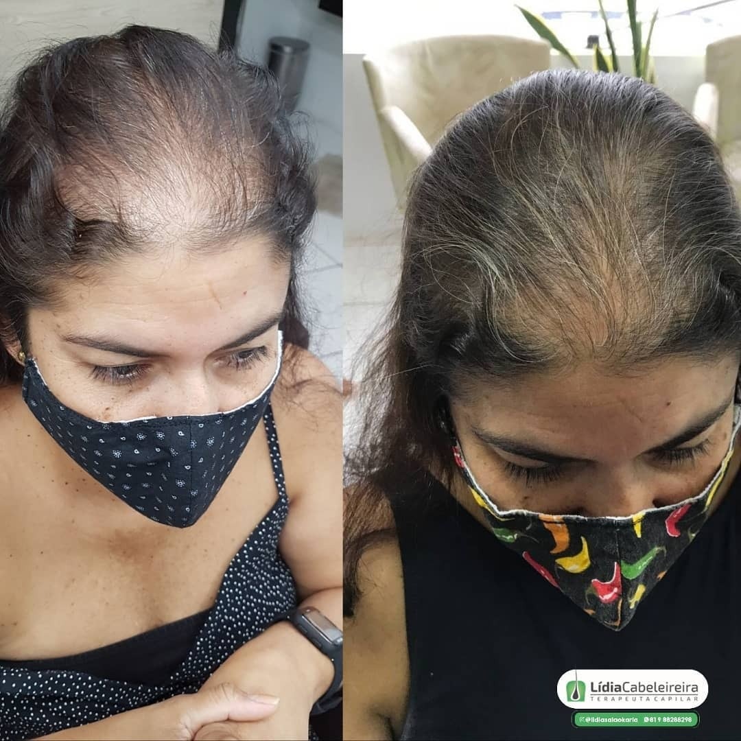 antes e depois de mulher com alopecia feminina