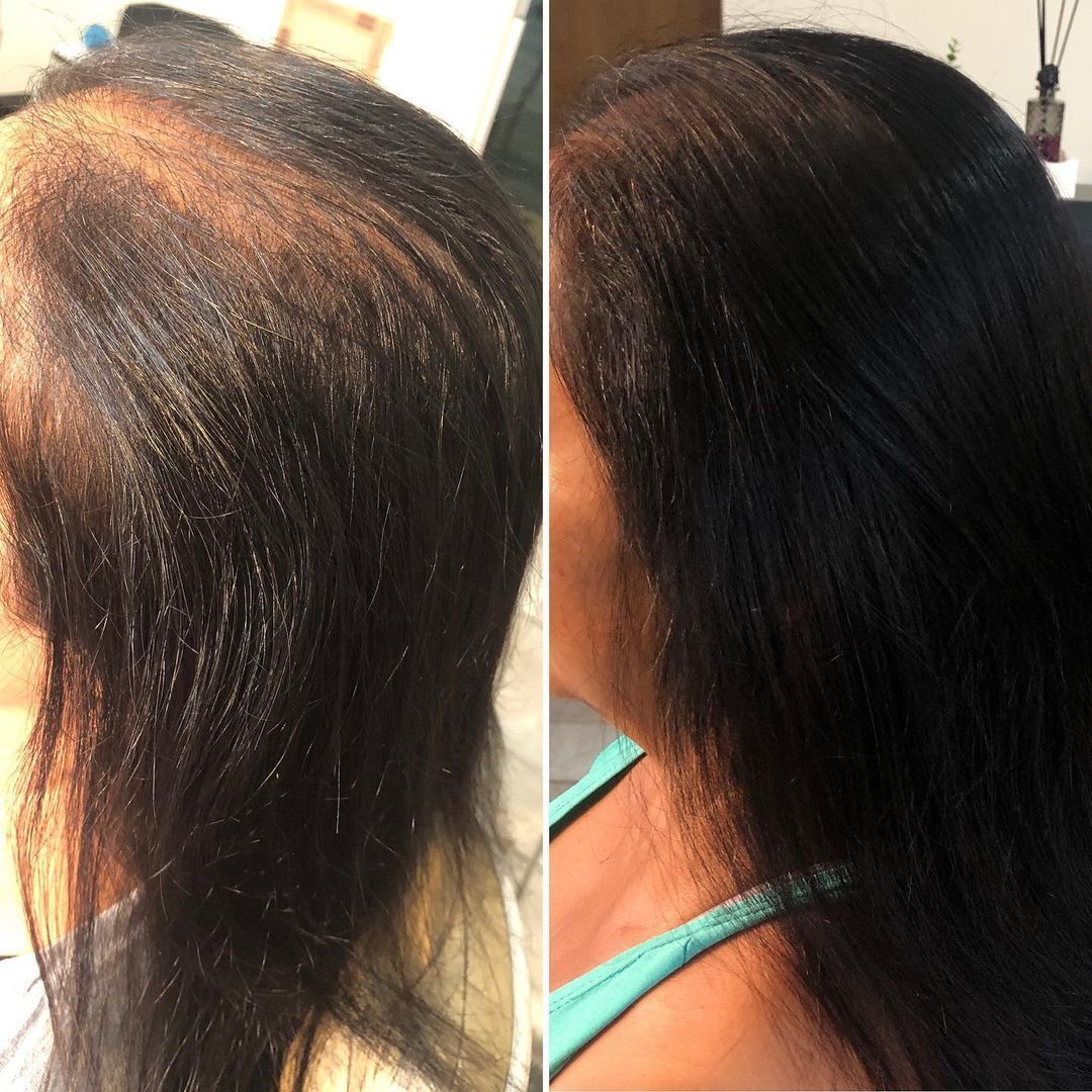mulher mostrando antes e depois de tratamento para calvície feminina