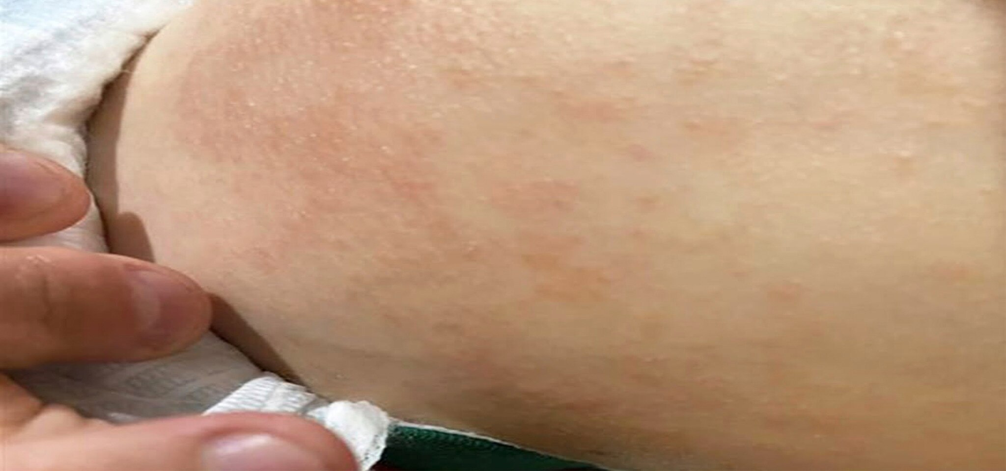 Atopic Dermatitis:Childhood Skin Condition
