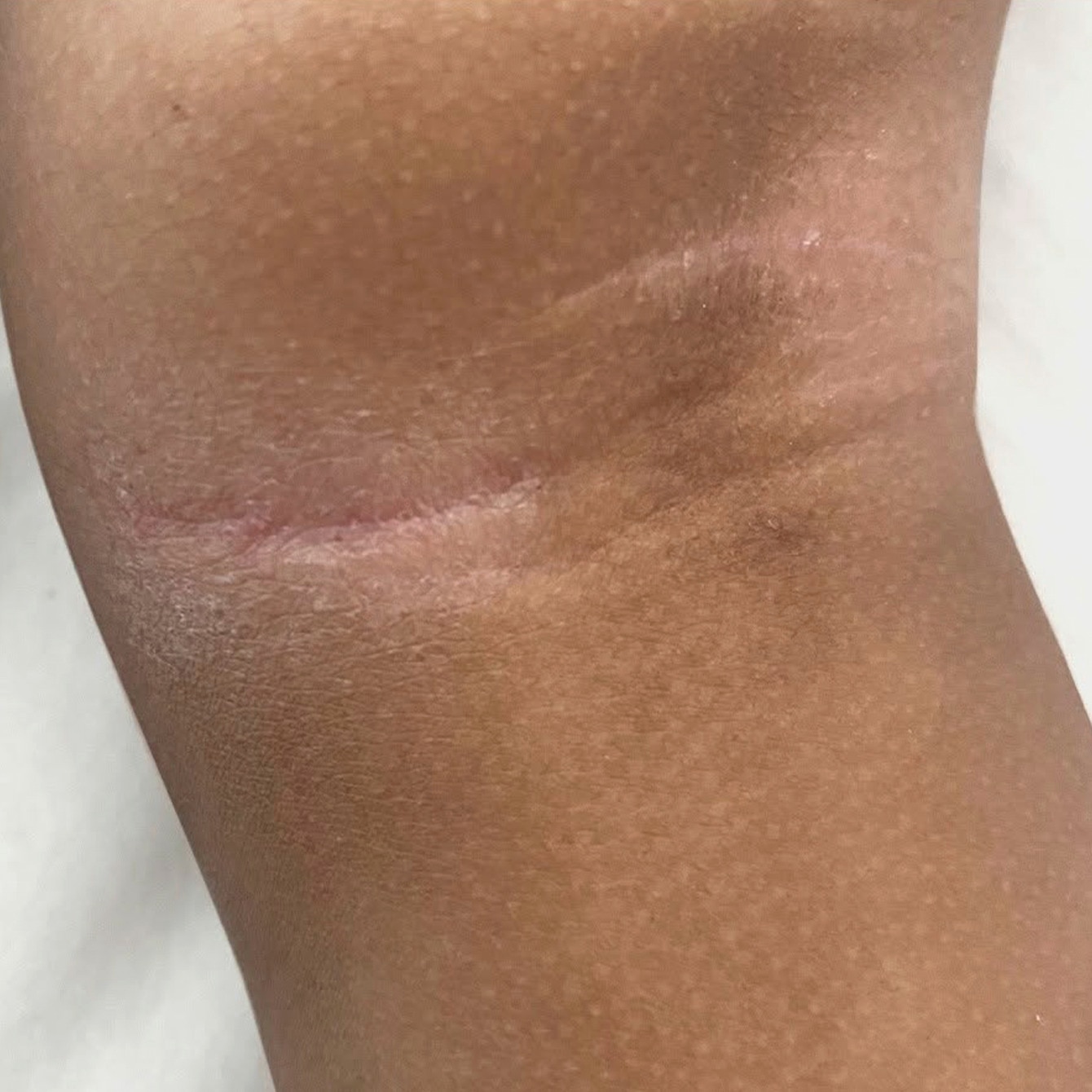 Atopic Dermatitis:Childhood Skin Condition